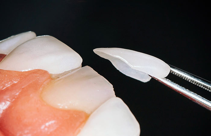 Carillas dentales de cerámica