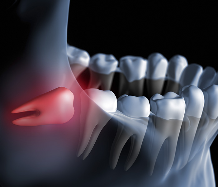 Extracciones dentales