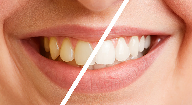 Resultados del blanqueamiento dental