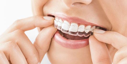 Ventajas de la ortodoncia Invisalign